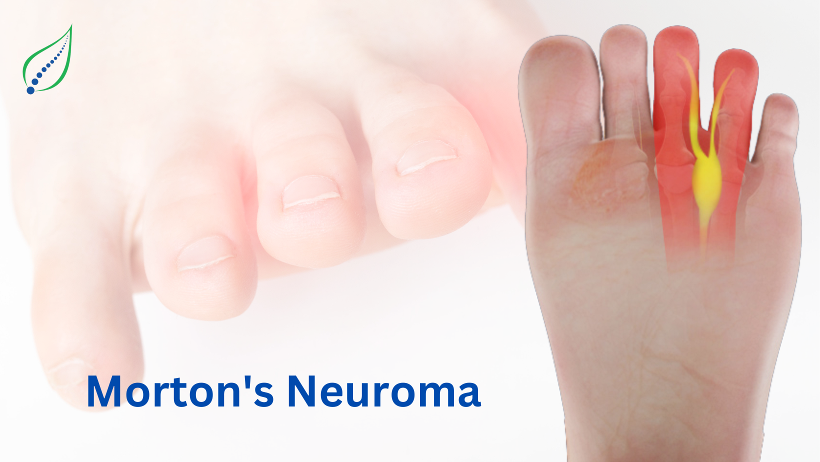 Morton’s Neuroma